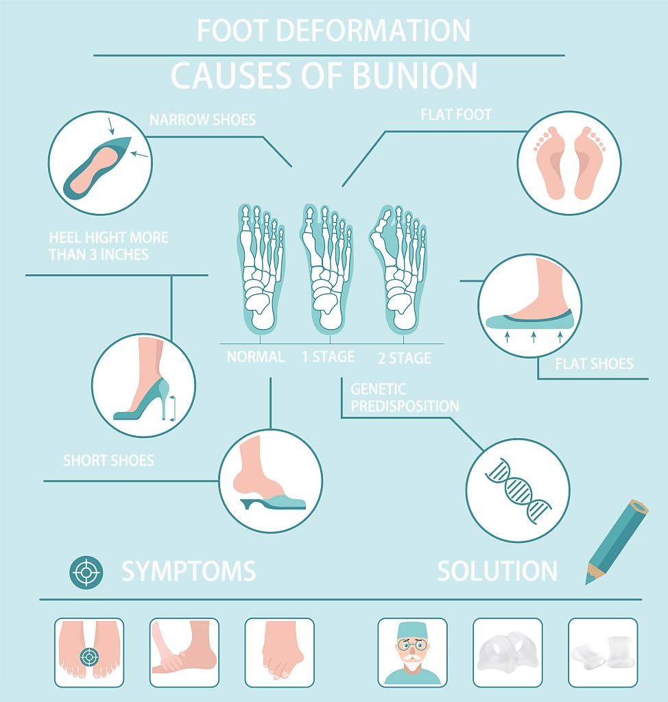 Unisex Bunion Corrector Big Toe & Tail Toe Pain Relief